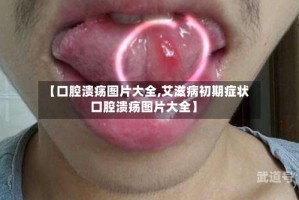 【口腔溃疡图片大全,艾滋病初期症状口腔溃疡图片大全】